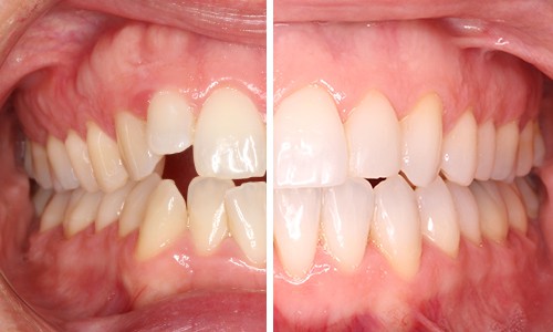 cuanto tiempo tienes que tener los brackets