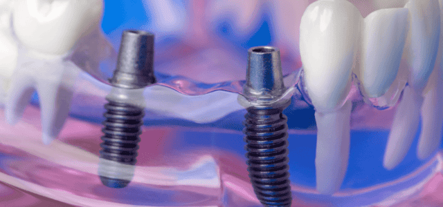 Base del implante dental