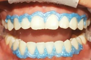 Cómo se hace el blanqueamiento dental con lámpara