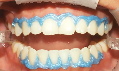 Resultado de imagen para blanqueamiento dental