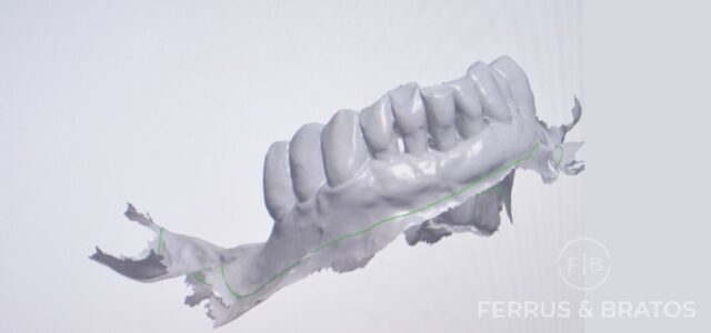 Hueso dental perdido