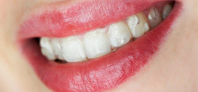 Ataches de Invisalign