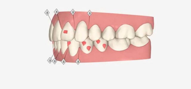 Ataches en Invisalign Simulación de ataches