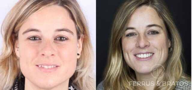 Adulto acomplejado por tener mal los dientes