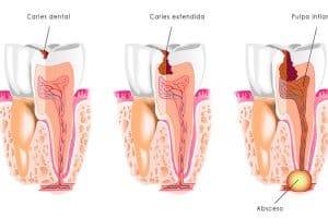 Presencia de la caries dental