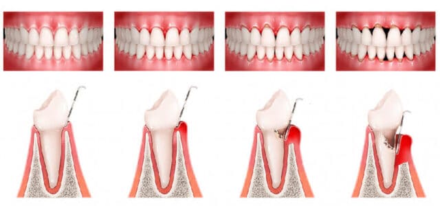¿Cómo se cura la periodontitis?