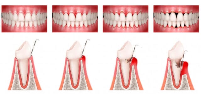 Periodontitis avanzada