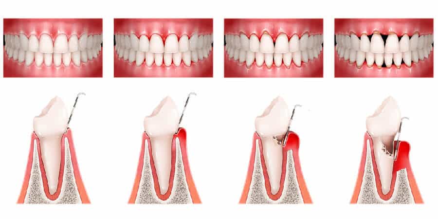 periodontitis crónica avanzada y diabetes periodontitis crónica avanzada y diabetes