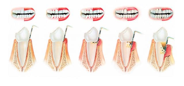 Enfermedad periodontal
