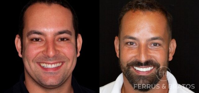 Blancorexia antes y despues
