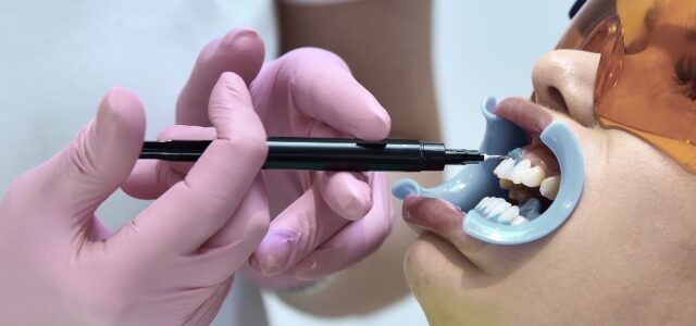 Blanqueamiento dental laser profesional en la Clínica Dental Ferrus & Bratos de Madrid Doctor aplica gel protector antes del blanqueamiento dental laser