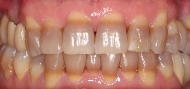 Contraindicaciones del blanqueamiento dental laser en Madrid Blanqueamiento dental laser se desaconseja en casos de tetraciclinas