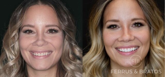 Antes y después de blanquear dientes en casa