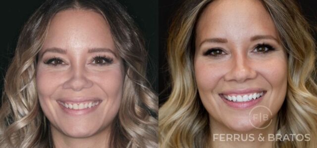 antes y depsues de blanqueamiento