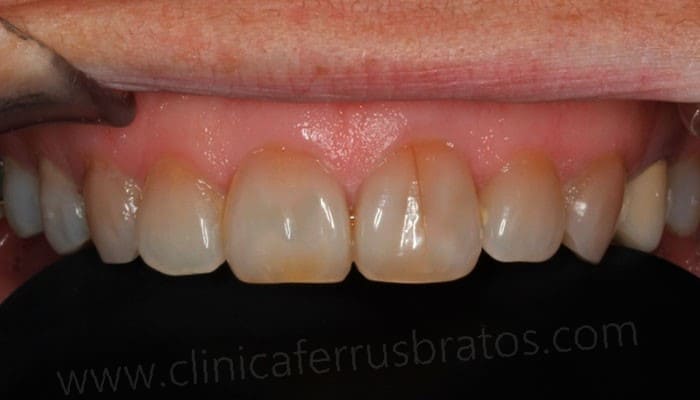 Antes