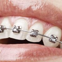 Brackets autoligables