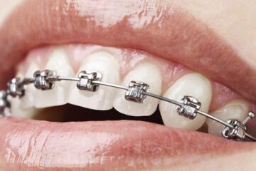 Brackets autoligables