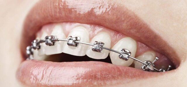 Brackets de autoligado Brackets autoligables