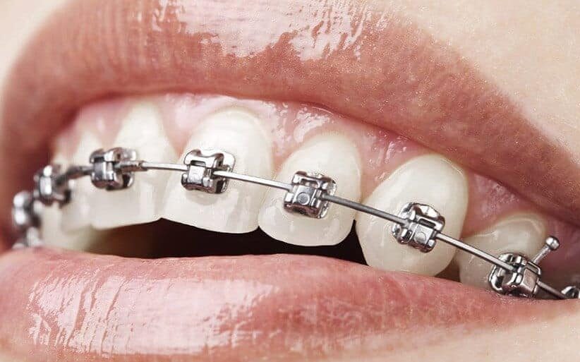 Brackets autoligables