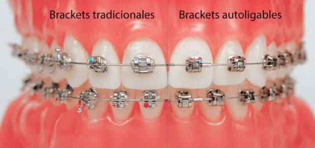 Brackets Damon metálicos