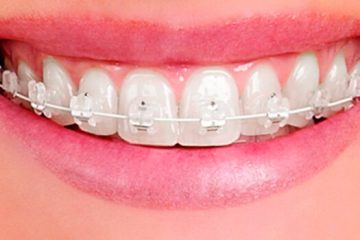 Brackets internos antes y despues de adelgazar