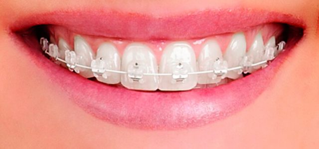 Donde puedo ponerme brackets baratos