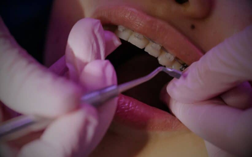 Los brackets estéticos, la opción favorita de los que buscan discreción Los brackets estéticos, una opción muy demandada por los pacientes de la Clínica Dental Ferrus & Bratos