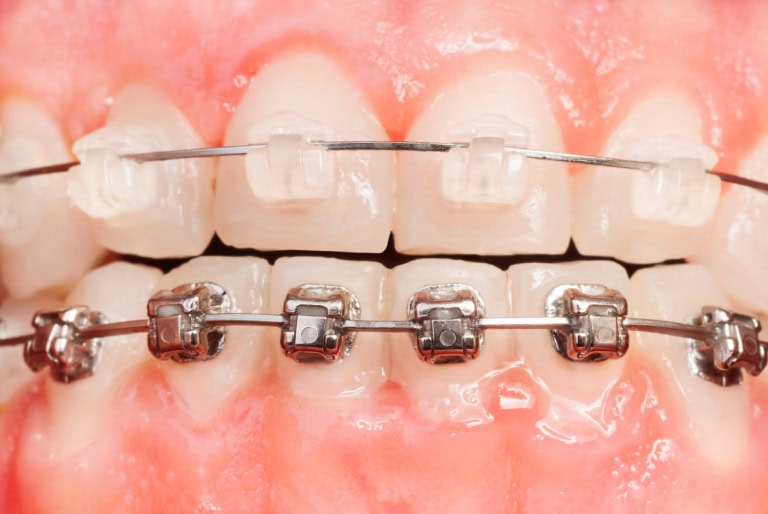 Brackets estéticos de zafiro