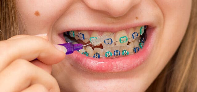 Brackets para niños