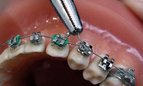 Puedo baratos brackets donde ponerme