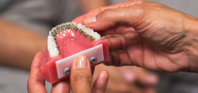 En la Clínica Dental Ferrus & Bratos ofrecemos opciones de brackets estéticos El aparato lingual, una opción de brackets estéticos que ofrece discreción durante el tratamiento