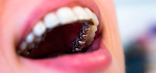 Brackets linguales precio Brackets por dentro