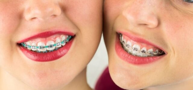 Brackets tradicionales metálicos para adolescentes