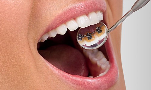 Cuanto cuesta los brackets linguales