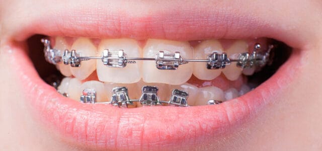 ¿Cuánto cuestan los brackets de metal?