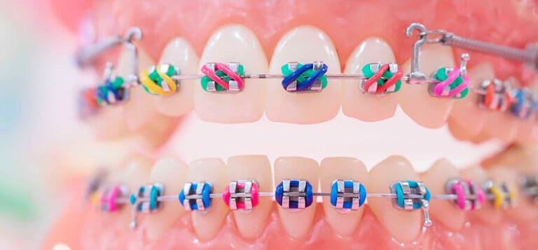 Brackets para niños: ¿Qué ventajas tienen y qué problemas corrigen?