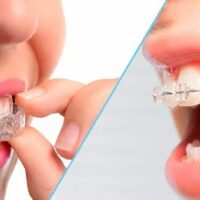 Ortodoncia con Invisalign