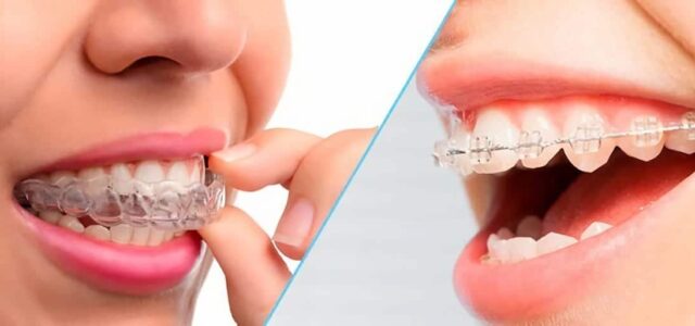 ¿Ofrece Invisalign buenos resultados como los brackets 