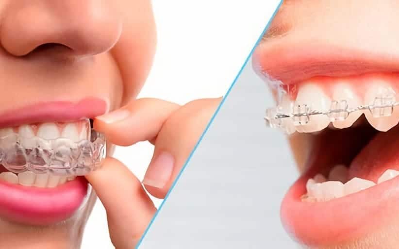 Ortodoncia con Invisalign