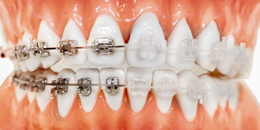 los brackets te cambian la nariz