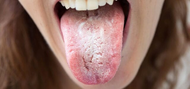 Lengua con candidiasis oral