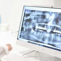 ¿Qué son los implantes de carga inmediata?