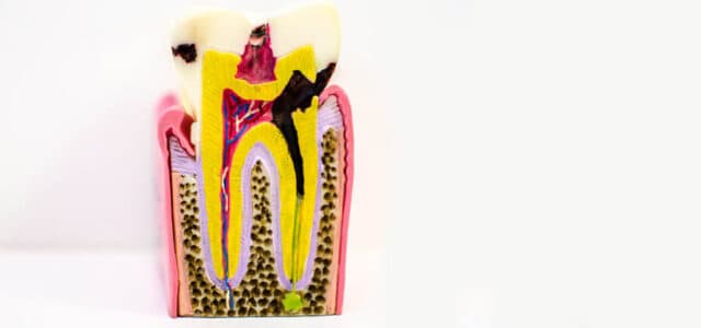 La alimentación se relaciona con las caries