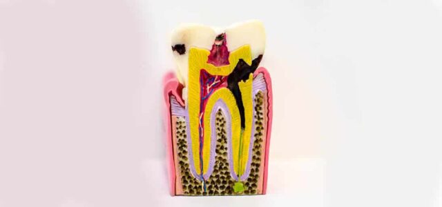 Caries qué es Caries dentales tipos
