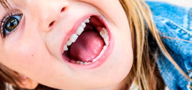 Caries infantiles