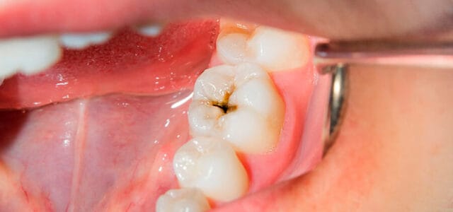 Diente con caries