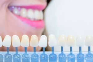 Diferencia entre carilla dental y corona