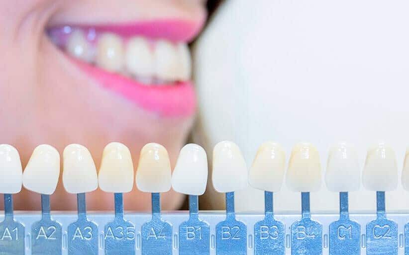 Diferencia entre carilla dental y corona