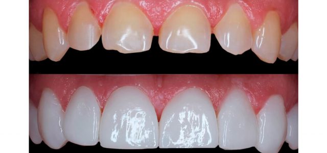 Modifican la forma y color de los dientes