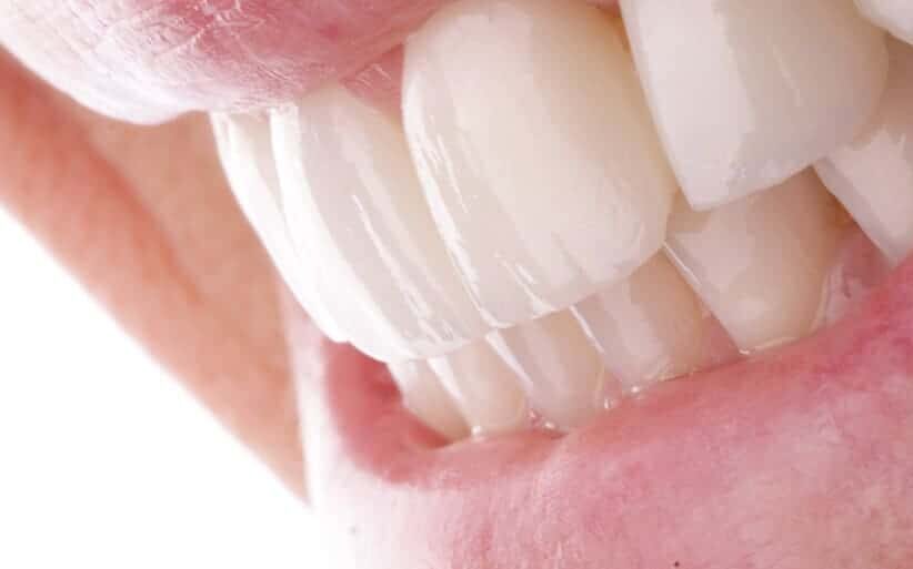 Carillas de porcelana Carillas de cerámica